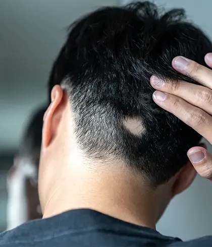 At home alopecia treatments