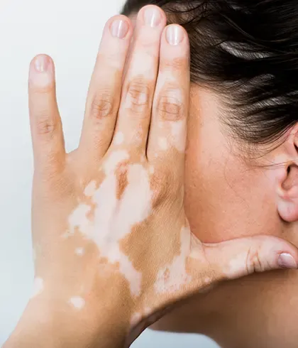 I have vitiligo: What should I do?