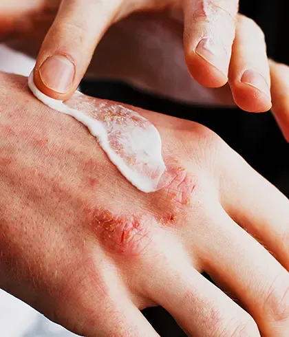 Is DermaHeal good for eczema?