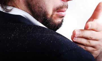 Seborrhoeic Dermatitis: Severe form of Dandruff