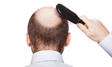 How to Cure Male Pattern Baldness