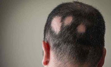 Causes and Treatment of Scarring Hair Loss