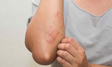 Watch Out for These Monsoon Skin Diseases