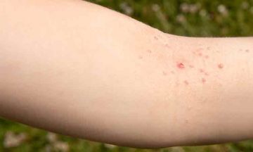 How to Get Rid of Warts the Holistic Way?