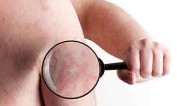 Don’t Fall for These Psoriasis Myths!