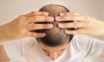 The Many Benefits of Homeopathy in Healing Hair Loss