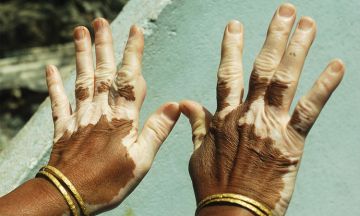 What causes Vitiligo skin disease?