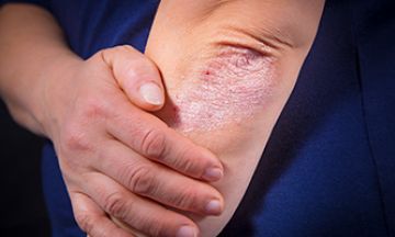 Why do people get Psoriasis?