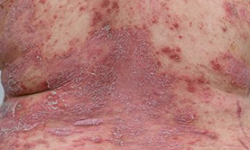 Types of Psoriasis and Benefits of Homoeopathic Treatment
