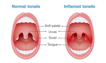 What are the symptoms of tonsils?