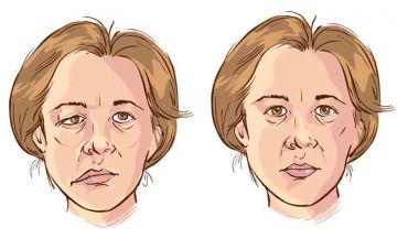 HOMEOPATHY & BELL’S PALSY