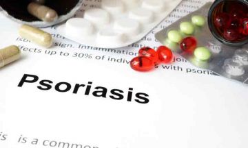 Guttate Psoriasis: Answering Important Questions