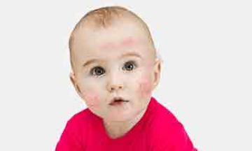 Does your child suffer from red itchy skin?
