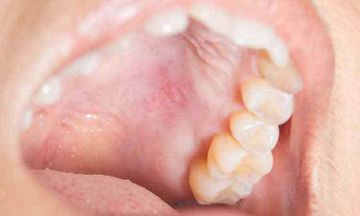 Is it just a Simple Mouth Ulcer?