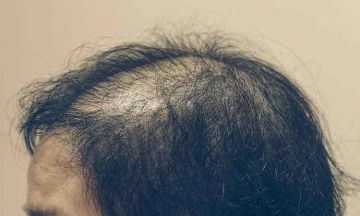 HOMEOPATHY TREATS THE CAUSE & EFFECT OF HAIR LOSS
