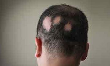  Efficacy of Homoeopathy in Patchy Hair Loss