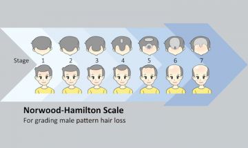 Hair Regrowth in Male Patterned Baldness Hair Regrowth in Male Patterned Baldness