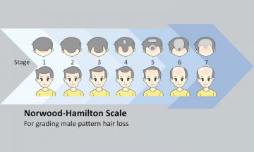 Hair Regrowth in Male Patterned Baldness