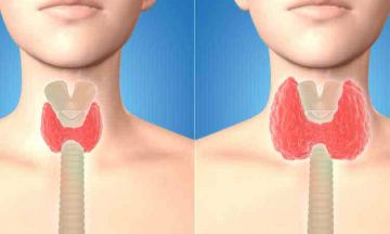 Hypothyroid Me to Healthy Me with Homoeopathy…