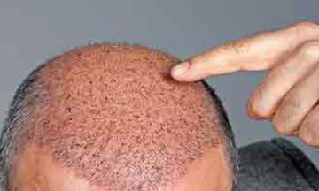 Dr Batra Hair Treatment Factory Sale, SAVE 50%. Dr Batra Hair Treatment Factory Sale, SAVE 50%.