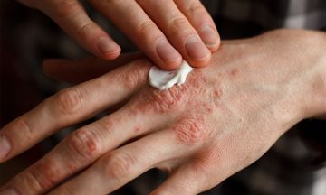 Homoeopathic Treatment for Psoriasis