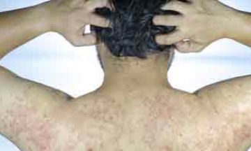 A Decade of Battling With Psoriasis Finally Resolved