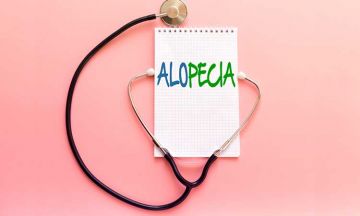  Alopecia Areata Treatment in Homeopathy