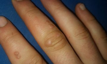 Different types of warts