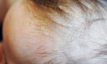 Does seborrhoeic dermatitis go away?