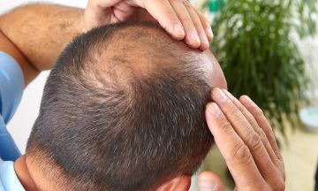 Factors responsible for causing Alopecia Areata