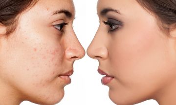 Get rid of pimples the natural way…