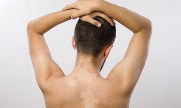 <p>Have you been suffering from white patches since long? Are you exhausted with all types of treatment? Try homeopathy and try to get rid of white patches… </p>  <p>Vitiligo is a pigmentation disorder as it causes the pigment making cells /color giving cells of the skin to deteriorate to produce milky white patches. Occurrence is equal in both sexes and all ages. In vitiligo there is a destruction of the skin pigment cells (melanocyte), which gives skin and hair it’s color through the formation of melanin 