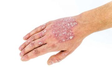 Homeopathy is a holistic way to treat Psoriasis