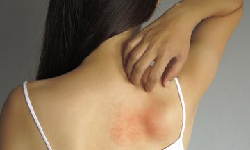 How to stop Psoriasis from Spreading?