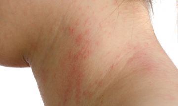 Homeopathic medicine is best for Psoriasis