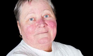 Rosacea is Not Acne……