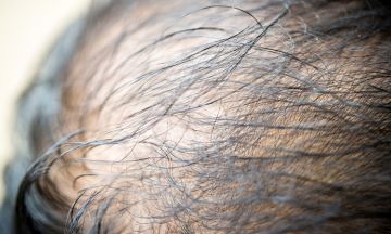 Understanding and combating Telogen Effluvium Hair Loss