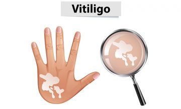 Vitiligo… when skin loses its pigmentation…