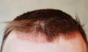 seborrheic dermatitis hair loss reddit