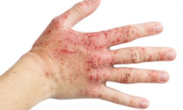 What are the 7 different types of Eczema?