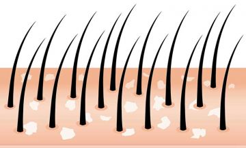 What causes Psoriasis of the scalp?