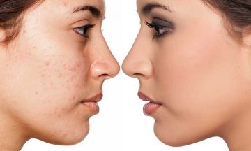 Why is homeopathy the best way to deal with acne or pimples?
