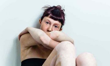 Understanding Vitiligo in Children