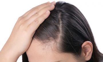 Thinning hair? It might be female pattern baldness.
