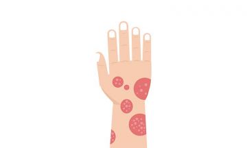 Psoriasis Or Eczema - What’s The Difference?