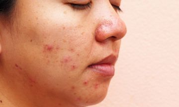 Adult acne isn't fun! Here's the best natural acne treatment