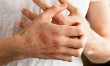 Itchy, flaky skin? You could be suffering from eczema skin disease