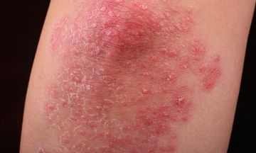 How to spot and treat psoriasis disease