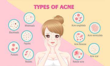 Thought acne was just a red spot? Know the different types of acne.