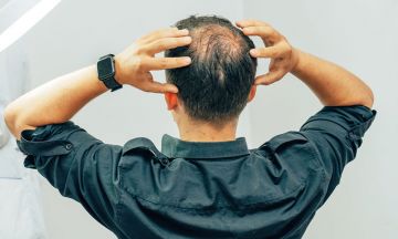 Started losing my hair at 20: Here's how I conquered Male Pattern Baldness